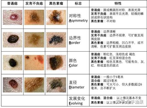 全身痣|痣是什麼？會變成黑色素瘤？7種一定要除的痣